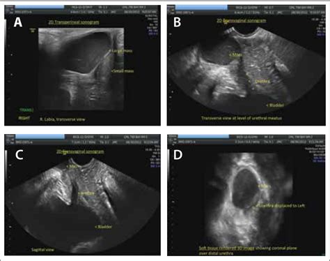 glande skene|Skenes Gland